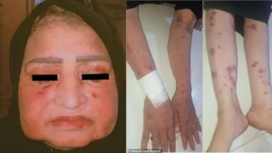 a-woman-who-took-medicine-for-fever-without-doctors-advice-admitted-to-icu